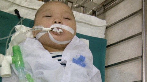 Nuốt phải xương, bé 9 tháng tuổi thủng ruột