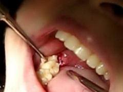 Bác sĩ để quên gạc trong... răng bệnh nhân