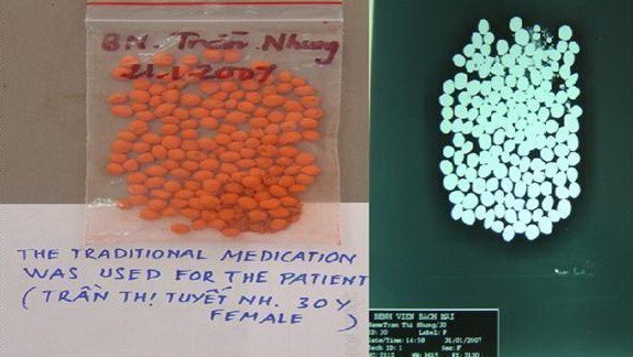 Hà Nội: Bé 8 tháng tuổi tử vong do ngộ độc chì từ thuốc cam