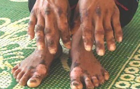 Bệnh lạ tại Quảng Ngãi: Bộ tư lệnh hóa học vào cuộc