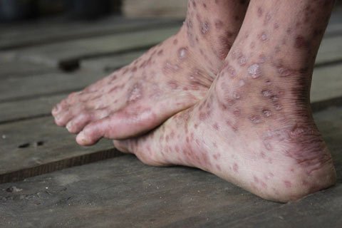 Công bố phác đồ mới trị 'bệnh lạ' ở Quảng Ngãi