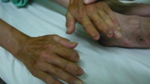 Cụt gần hết ngón tay vì hút thuốc lá