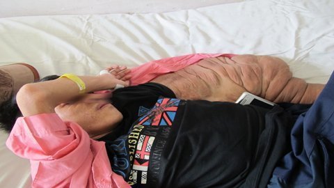 Phẫu thuật cho người vẹo cột sống vì 'u quái'