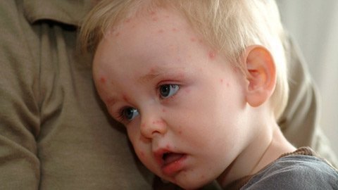 Chủ động chủng ngừa, ứng phó với thủy đậu mùa cao điểm