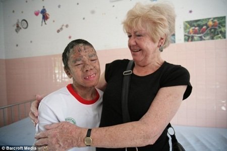 Người phụ nữ Anh 15 năm chăm sóc cậu bé Việt bị 'vảy cá'