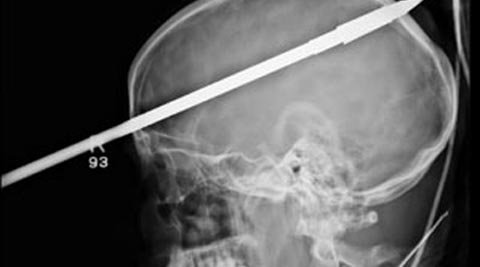 Tên xuyên qua não, vẫn sống sót