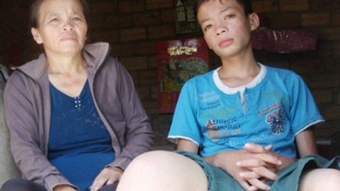 Nỗi đau cậu bé chân voi