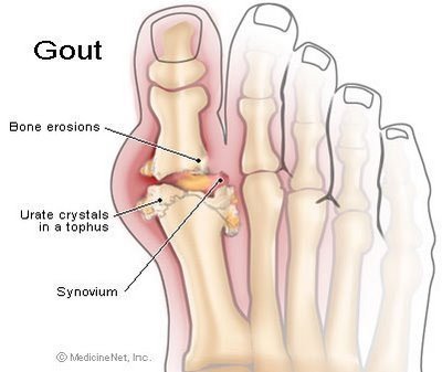 Bệnh gout - Nỗi khổ khó chia sẻ