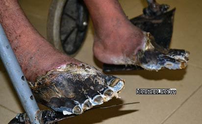 Kinh hoàng hai bàn chân người sống bỗng nhiên chết khô