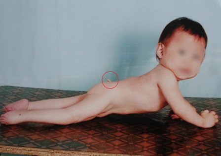 Bé gái 2 tuổi 'mọc' đuôi