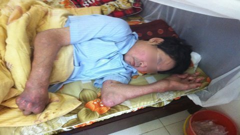 Cơ thể biến dạng kinh dị vì…ăn uống bừa bãi