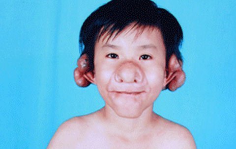 Xót xa cậu bé mang khuôn mặt 'Trư Bát Giới'