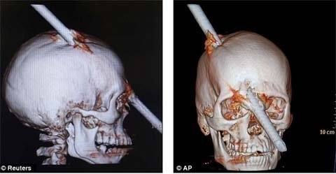 Thoát chết thần kỳ khi bị gậy xuyên qua sọ