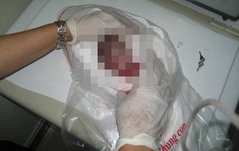 Xót lòng vụ xác thai nhi bị ném đi ném lại