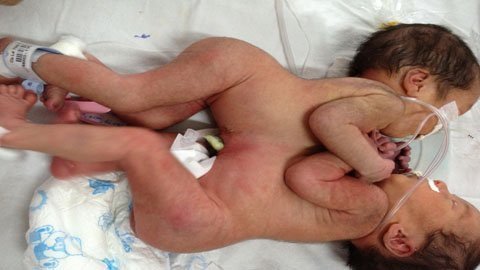 Cặp song sinh dính nhau và kỳ tích 24 năm trước