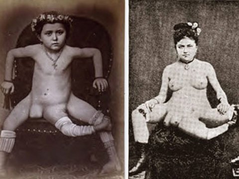 Lạ lùng những người có hai bộ phận sinh dục