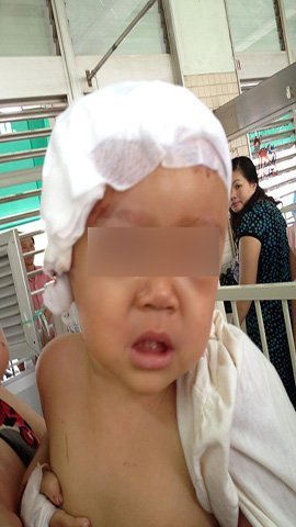 TP.HCM: Cứu bé 10 tháng tuổi bị thanh sắt xuyên qua đầu
