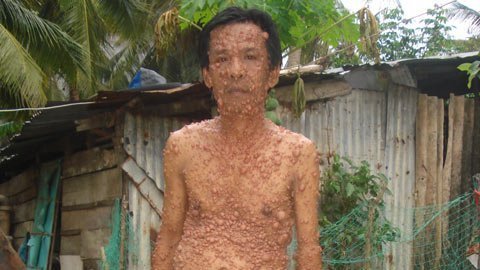 Thêm một người mang ngàn cái bướu