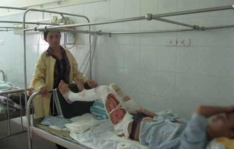 Nam sinh suýt bỏng 'của quý' vì nổ cồn nướng mực