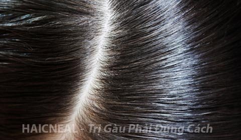 Chọn đúng “trợ thủ” diệt gàu