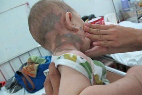 Một phụ nữ và 3 trẻ nhỏ bị tạt axit dã man