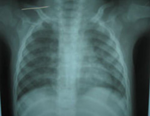 Xẹp phổi vì sặc xương heo, một bé trai suýt chết