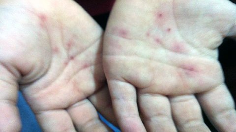 Gia đình ‘tố' cô giáo dùng vật nhọn đâm tay con