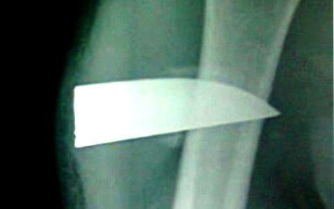 Bị dao nhọn cắm sâu 7cm vào người