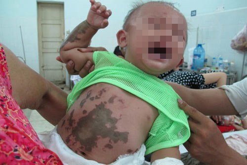 Bắt giam gã chồng tạt axít vào vợ con