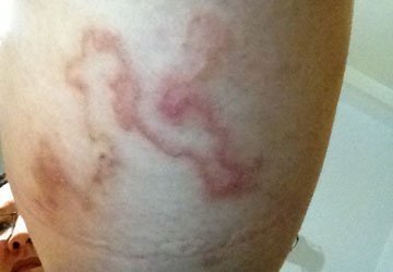 Phát hoảng vì đắp bùn làm đẹp bị nhiễm giun móc chó