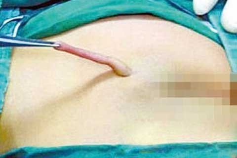 Bé gái chào đời với đuôi dài 6cm