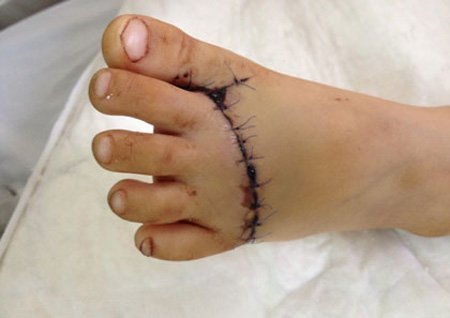 Bé gái gần đứt lìa bàn chân vì miếng chắn pô xe máy