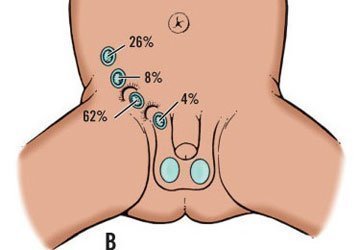 Chữa u buồng trứng, ngỡ ngàng phát hiện có... tinh hoàn