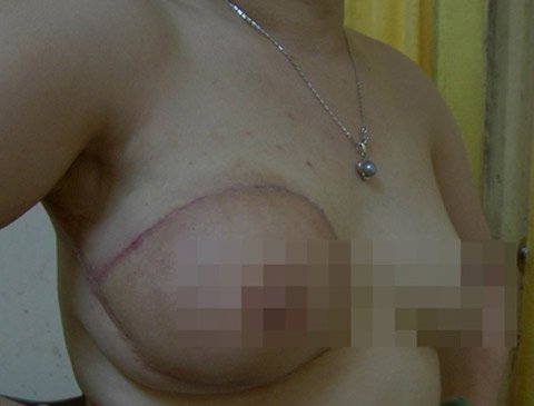 Bị cắt 'của quý' vì ung thư vẫn dùng tốt