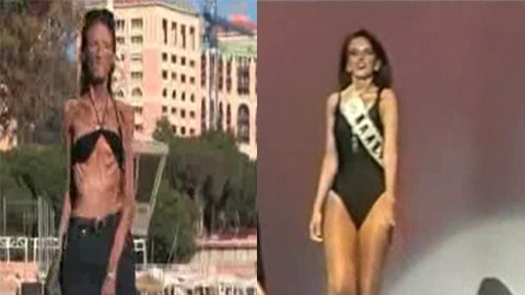 Cám cảnh người mẫu biến thành 'bộ xương di động'