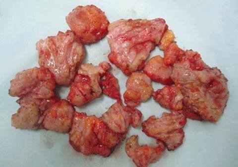 Nam nhi suýt chết vì bơm ngực, độn mông