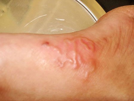 Ăn hải sản sống, giun lươn bò lúc nhúc dưới da