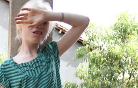 Hai chị em mắt đỏ rực, sợ ánh sáng