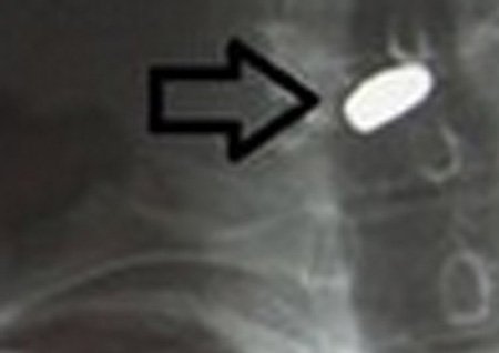 Suýt chết vì tưởng súng bút là đồ chơi