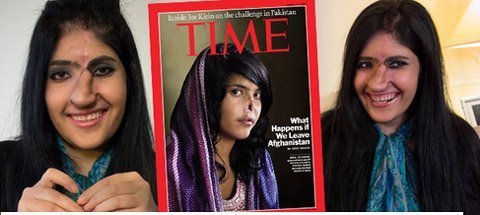 Cô gái Afghanistan mất mũi 