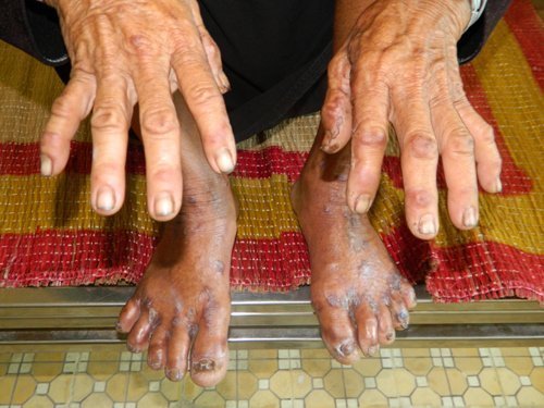 Cả gia đình mắc 'bệnh lạ' ở Quảng Ngãi