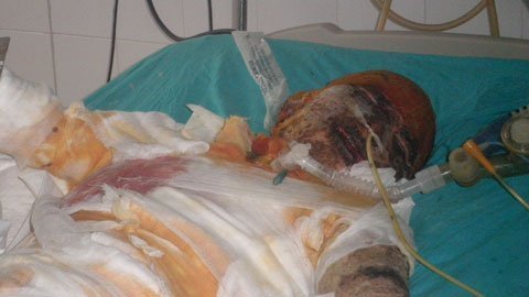 Giúp hàng xóm lợp nhà, thanh niên trẻ bị bỏng nặng