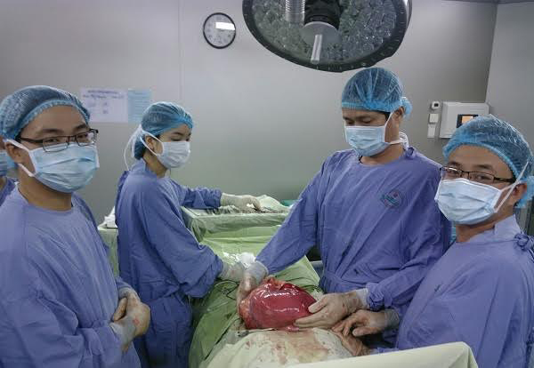 Lấy khối u nặng 6,5kg ra khỏi ổ bụng bệnh nhân