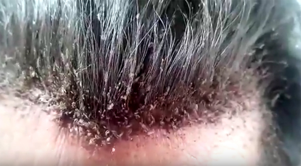 Tâm điểm KH: Cả triệu con chấy sống trên đầu người đàn ông