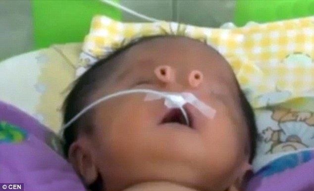 Sức sống mạnh mẽ của em bé có lỗ mũi dị thường
