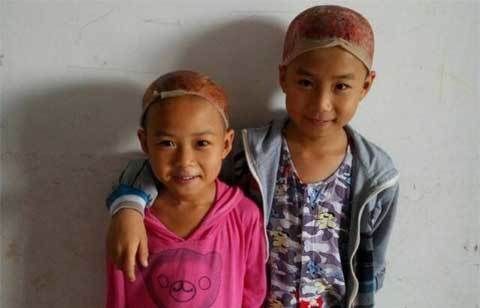 Cảm động hai em bé hiến da đầu cứu cha bỏng nặng