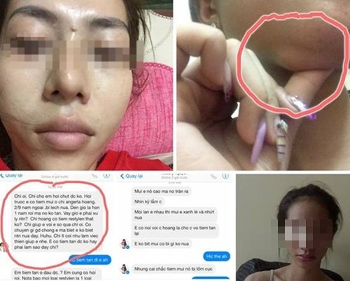 Hàng loạt chị em 'cằm méo, mắt trợn' do tiêm chất làm đầy dởm