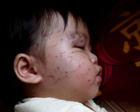 Bé 11 tháng tuổi bị bạn cắn, cào nát mặt khi đi nhà trẻ