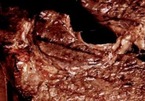 Thịt đỏ gây nguy cơ ung thư ngang với thuốc lá