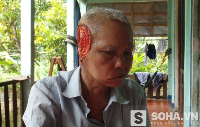 Căn bệnh khủng khiếp 'ăn' mất tai người đàn ông ở Tiền Giang